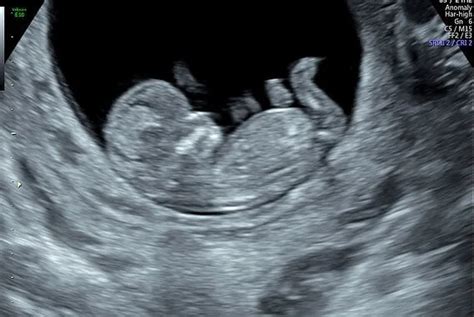 ultrasound obstetric dating scan